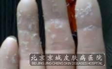 白斑早期症状图片